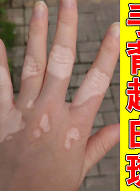 手背长白斑男女通用身上皮肤有白色斑块手上起白斑汗斑花斑