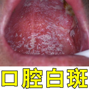 口腔白斑黏膜修复上颚发白糜烂疼痛免疫力下降口腔感染喷剂