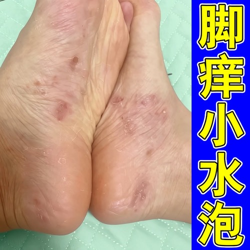 脚痒长小水泡蜕皮干燥粗糙脚出汗刺挠真菌脚趾缝干痒脚后跟干裂药