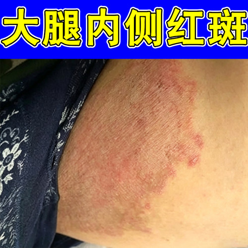 大腿内侧红斑干燥表面皮肤粗糙长小红点疙瘩大腿内侧痒起皮掉屑痒