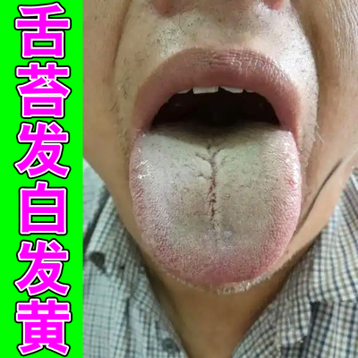 舌苔发白发黄肠胃膏贴舌面白厚腻表面粗糙舌苔白厚舌头裂纹有齿痕