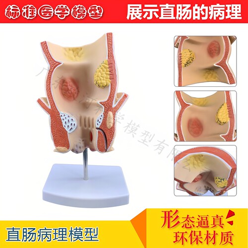 痔疮结肠病解剖教具模型