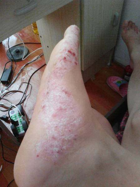 手痒水泡脱皮水泡型季节性反复手鲜手足干裂手脚养起小水养泡泡