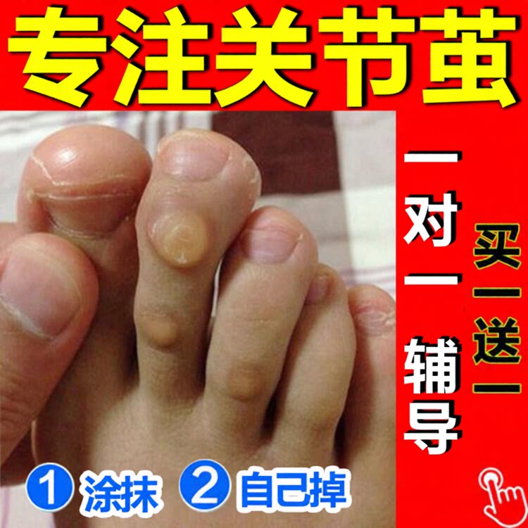 绣医阁肉刺厚茧眼关节茧老茧脚垫