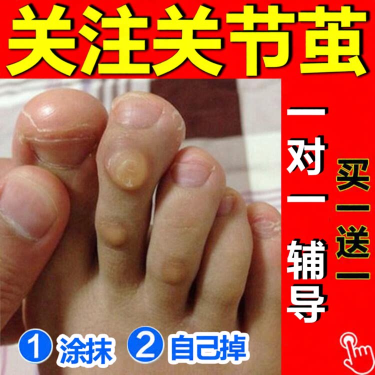 去脚趾头关节茧老茧膏贴肉刺除脚茧软化剂脚垫根手厚硬死皮老茧净