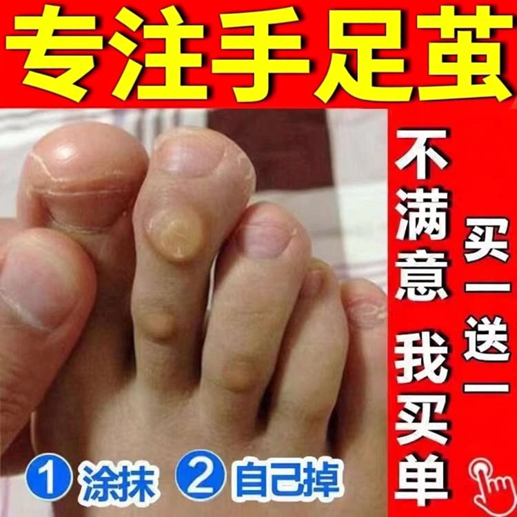去脚趾头关节茧老茧膏贴肉刺除脚茧软化剂脚垫根手厚硬死皮老茧净