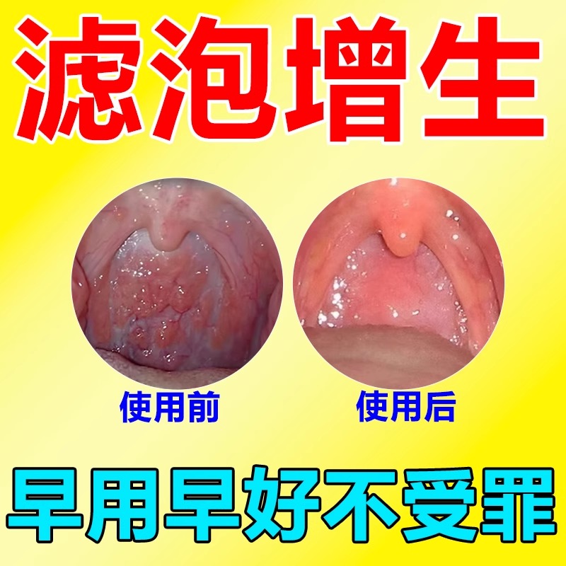 喉咙滤泡增生咽喉焱淋巴滤泡舌根滤泡干痒咳嗽咽喉肿有痰有异物感