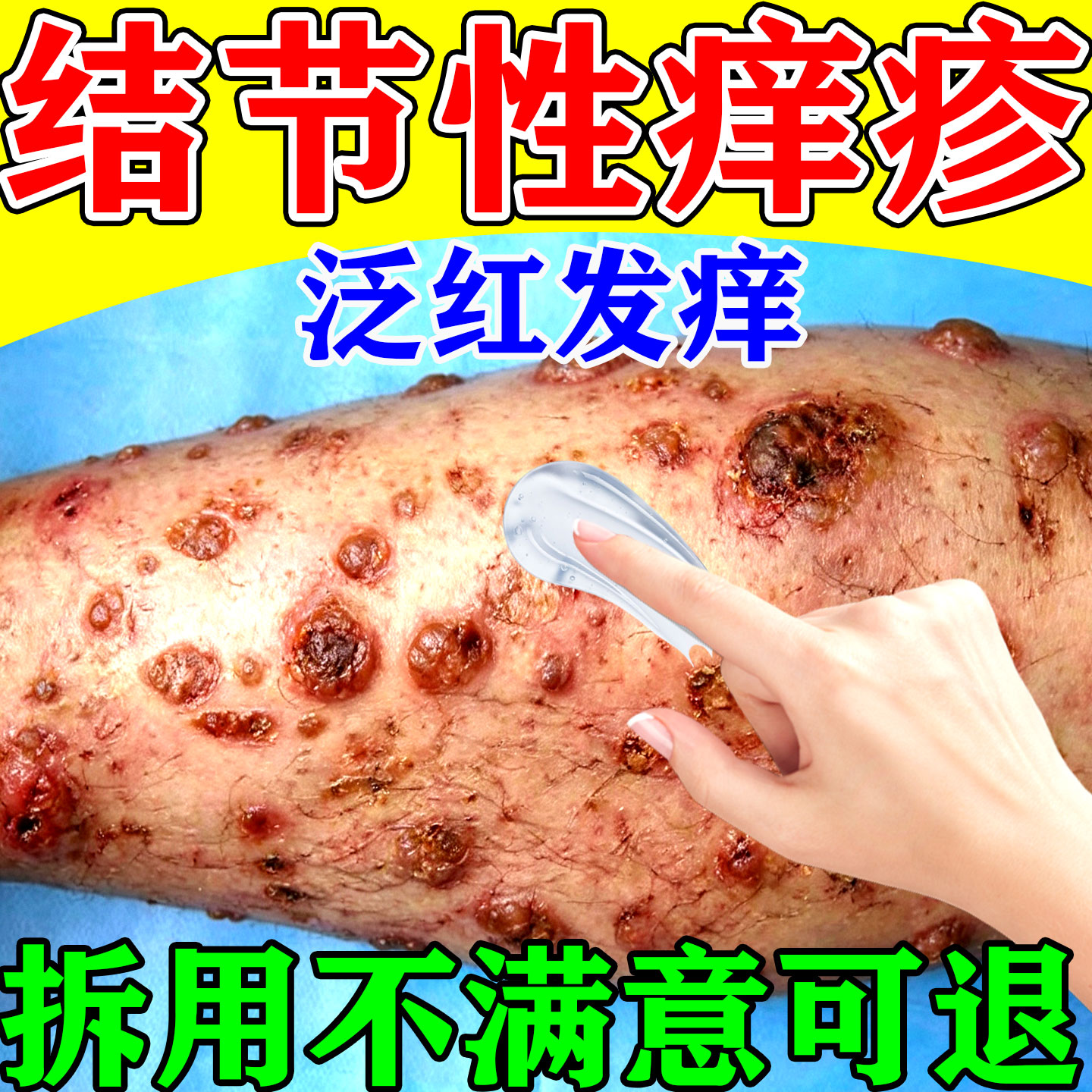 结节性痒疹特i效治顽固红硬疙瘩皮肤湿i疹皮炎专用止痒抑i菌膏药