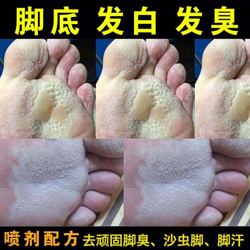 去除脚臭臭脚粉止汗剂除臭泡脚汗根汗脚出汗喷剂沙虫脚药防治喷雾