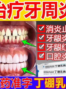 丁硼乳膏牙膏正品治牙周炎牙龈肿痛消炎口腔修复萎缩官方旗舰店sy