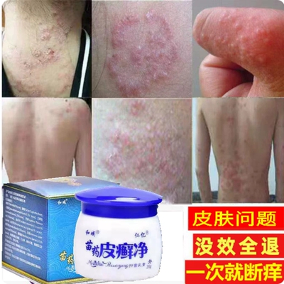 苗方皮癣苗药草本神经性皮炎大腿内侧止痒抑菌膏顽固股藓