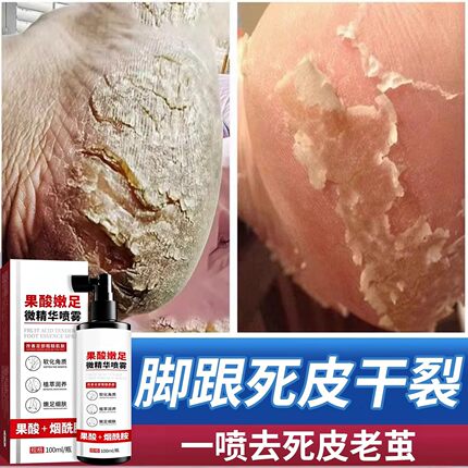 果酸嫩足精华去角质脱皮喷雾去死皮老茧防干裂脚后跟滋润保湿补水