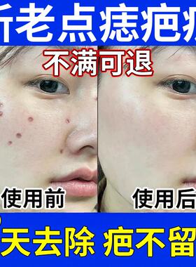 点痣不留疤药水去痣祛痣无痕祛除脸上黑痣痦子c美容院瘊专用