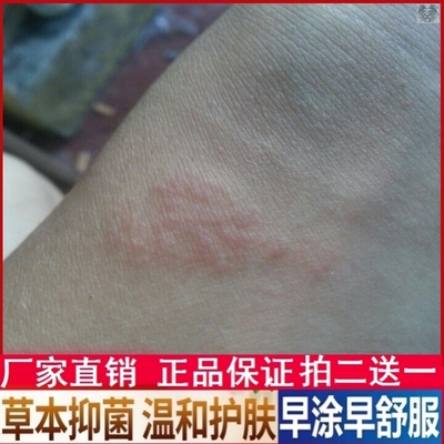 伊曲康挫真菌软膏正品伊依曲康挫唑乳膏真菌软膏抑菌草本止痒膏