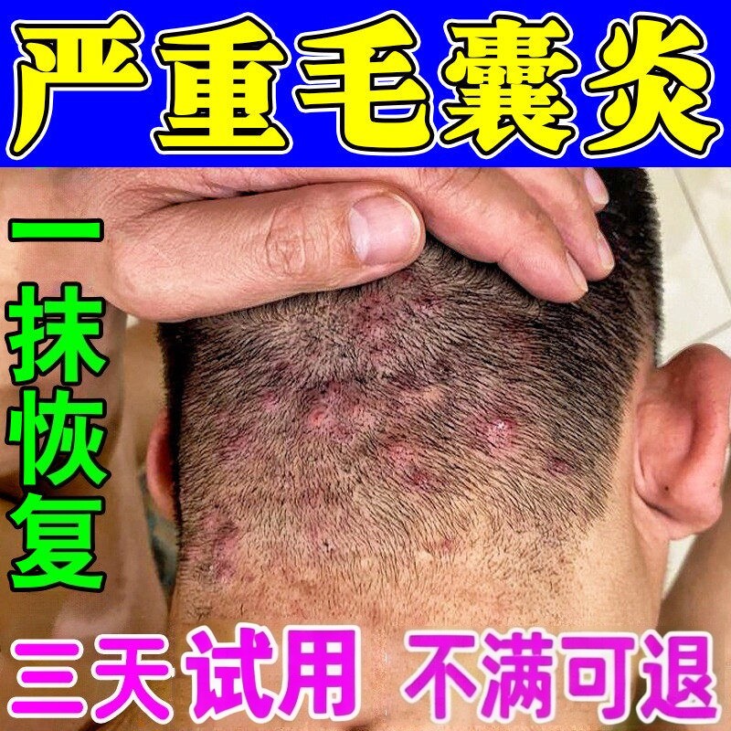 头皮毛囊炎效特膏专用头上长痘痘红疙瘩脓包红肿痒疼止痒抑菌软膏