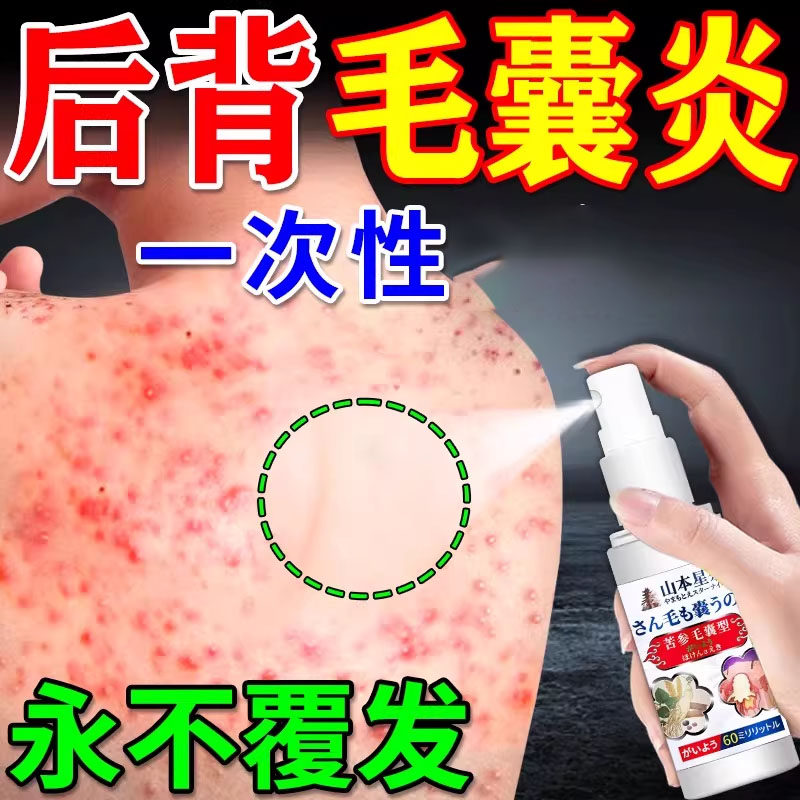 毛囊炎喷雾剂后背上长痘痘毛囊炎除螨祛痘痒马拉色真细特菌效喷药