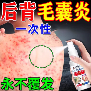 毛囊炎喷雾剂后背上长痘痘毛囊炎除螨祛痘痒马拉色真细特菌效喷药