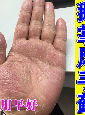 鹅掌风专用药手癣手脚严重脱皮干裂菌抑痒止膏手气手上小水泡真菌