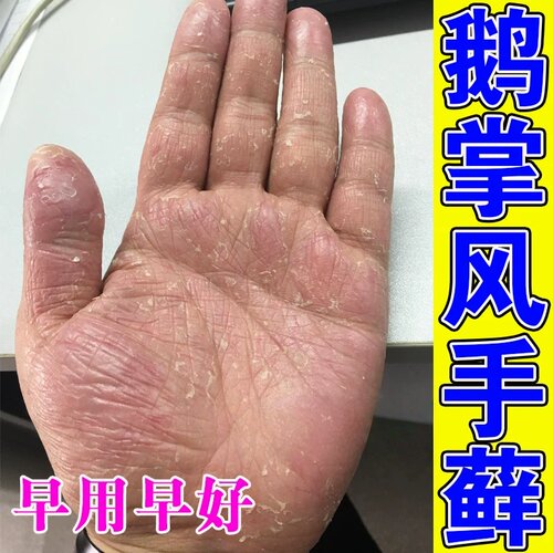 鹅掌风专用药手癣手脚严重脱皮干裂菌抑痒止膏手气手上小水泡真菌