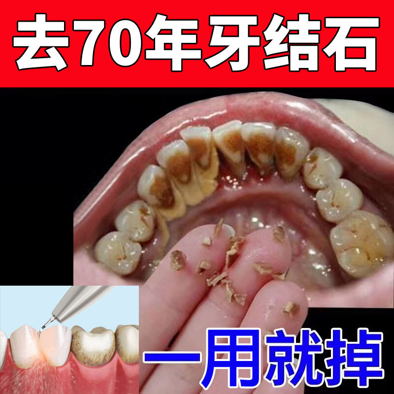 超声波牙结石去除器溶解清理工具祛牙垢烟牙渍速效洗牙神器洁牙仪