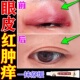 眼皮红肿痒眼睛周围过敏发痒干燥起皮眼角痒神经性皮痒杀菌止痒膏