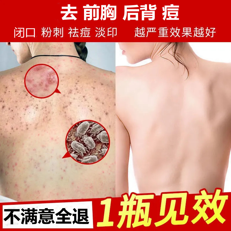 后背祛痘去背上痘痘背部痘痘印痘坑淡化消印炎去除粉刺男女神器膏