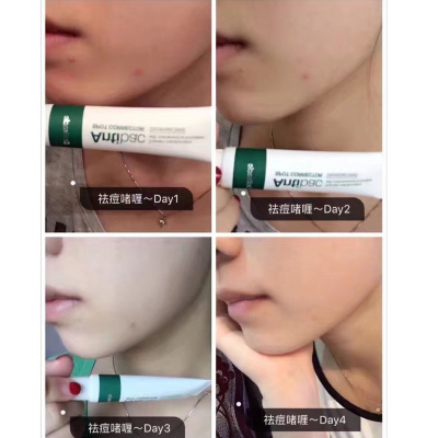 祛痘防止痘印韩国正品局部使用