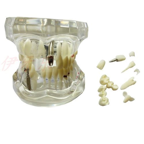 教学修复模型带植烤瓷病理嵌体矫正水晶饰品特价高速手机