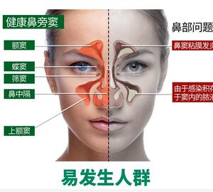 鼻舒宁蛇胆复合酶喷剂保健组合套装百草膏鼻不通鼻子痒不通气透流