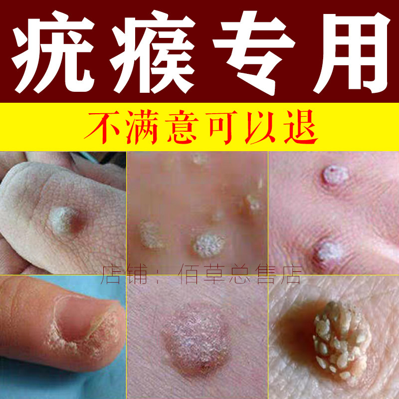 去尤瘊扁平疣丝状疣脖子腋下长肉粒皮赘头上肉疙瘩一抹无忧点痣膏