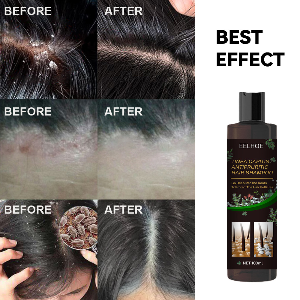 Anti-itchingShampoodandruff