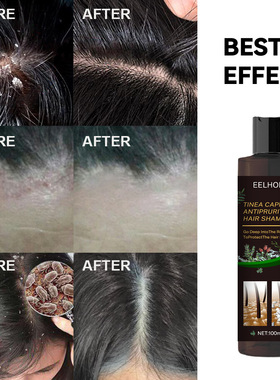 Tinea Dispelling Anti-itching Shampoo dandruff止痒洗发水去屑