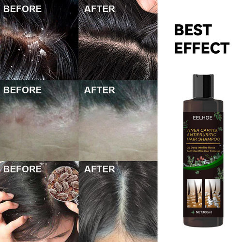 Anti-itchingShampoodandruff