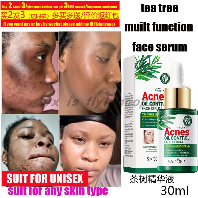 AcneTreatmentFaceSerum精油