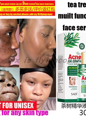 AcneTreatmentFaceSerum精油
