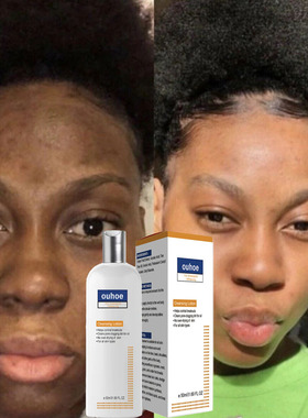 Canthosis Nigricans Therapy Cream Replenish Water spot洁面乳