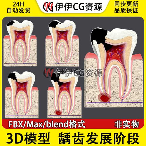 3D模型3Dmax医学模型龋齿发展阶段浅龋中龋深龋牙髓炎根尖炎牙龈