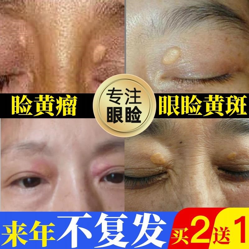 去除睑黄疣长黄色瘤眼部黄睑疣瘤睑黄瘤斑圆眼睑黄斑瘤健康膏