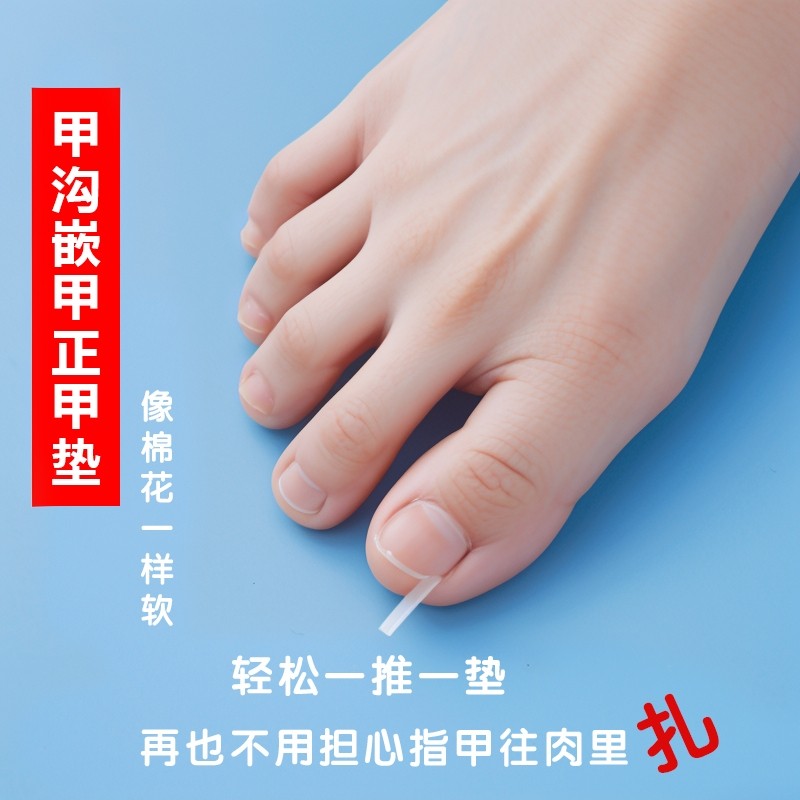 甲沟矫正器炎神器正甲贴指甲贴片嵌甲脚趾甲往肉里长纠正填充垫片,家庭/个人清洁工具,美甲/修甲套装,淘宝优惠券,粉丝福利购,淘宝优惠卷