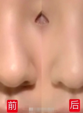 鼻中隔偏曲修复精华  改善歪鼻偏移不规则立体美鼻精油加强版