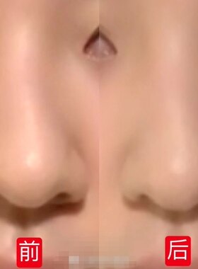 鼻中隔偏曲修复精华  改善歪鼻偏移不规则立体美鼻精油加强版