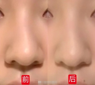 鼻中隔偏曲修复精华  改善歪鼻偏移不规则立体美鼻精油加强版
