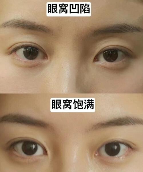 草本眼窝凹陷修复精华 改善泪沟眼袋饱满眼部精油加强版