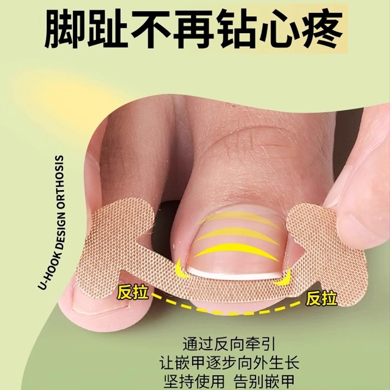 甲沟神器指甲矫正器隔离脚趾甲