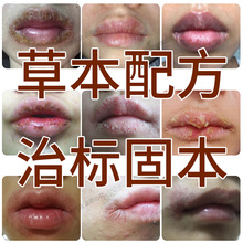 唇康灵唇炎唇膏修复嘴唇红痒干裂干燥脱皮起皮起水泡嘴角口角开裂