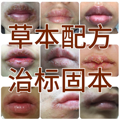 唇康灵唇膏嘴唇红痒干裂干燥脱皮起皮起水泡嘴角口角开裂