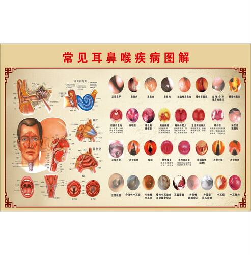 耳鼻喉常见疾病图海报