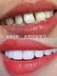 义获嘉美牙超薄美白瓷贴面陶瓷全瓷贴片烤瓷牙片牙缝牙齿假牙