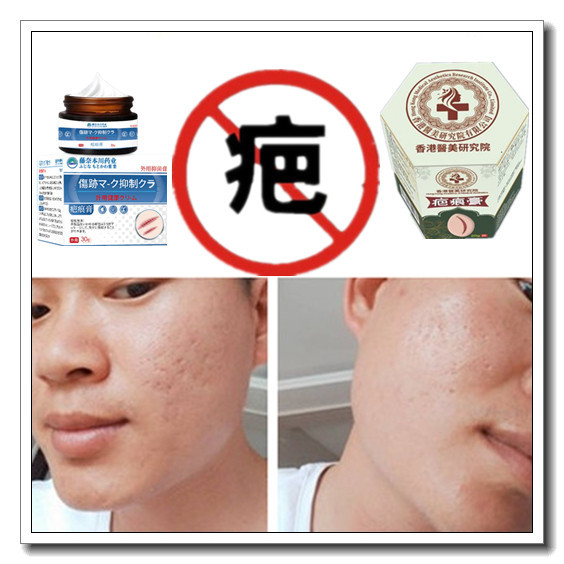 正品去除手术烟烫疤痕印消祛儿童增生性突疤疙瘩软化烧伤药膏产品,孕妇装/孕产妇用品/营养,妊娠纹护理,淘宝优惠券,粉丝福利购,淘宝优惠卷
