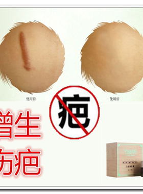 去除儿童脸面部烧烫伤疤痕的药淡化黑色素暗沉专用凹凸克星修复膏